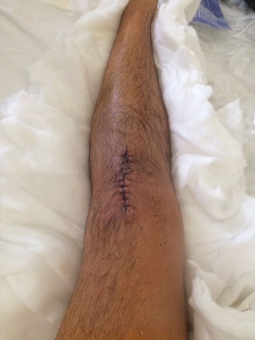 knee after operation